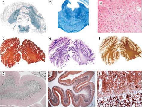 https://cdn.ncbi.nlm.nih.gov/pmc/blobs/705e/3693083/bf116c451ee8/clinneuropathol-31-127-03.jpg
