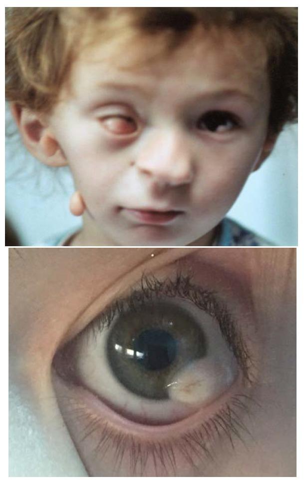 https://cdn.ncbi.nlm.nih.gov/pmc/blobs/7070/6117527/12a7e8df7a3a/RomJOphthalmol-62-96-g0011.jpg