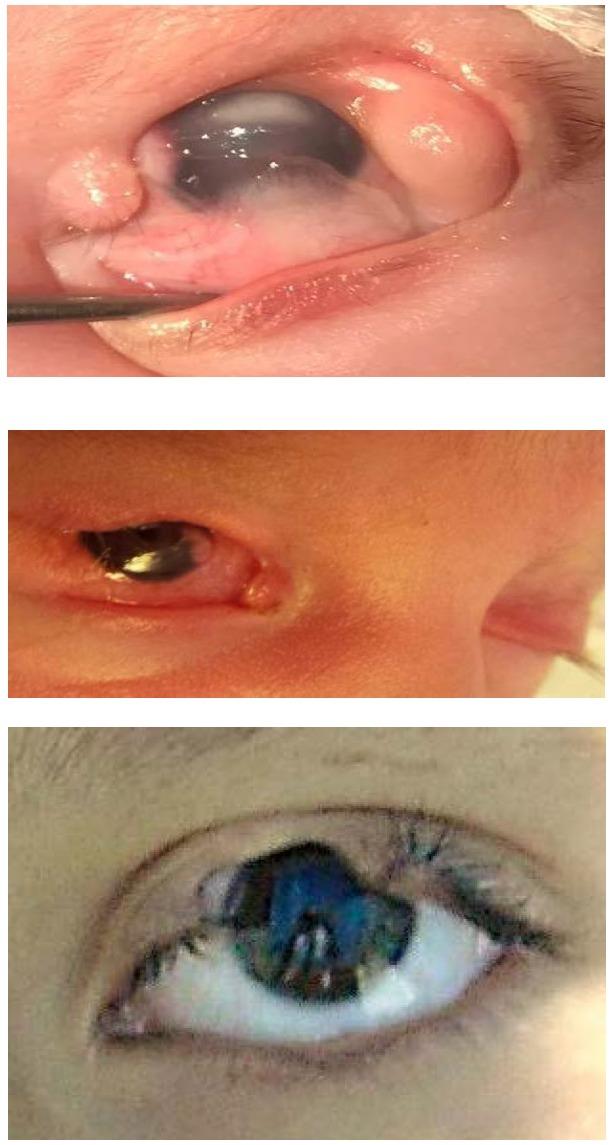 https://cdn.ncbi.nlm.nih.gov/pmc/blobs/7070/6117527/4adaedeede73/RomJOphthalmol-62-96-g003.jpg