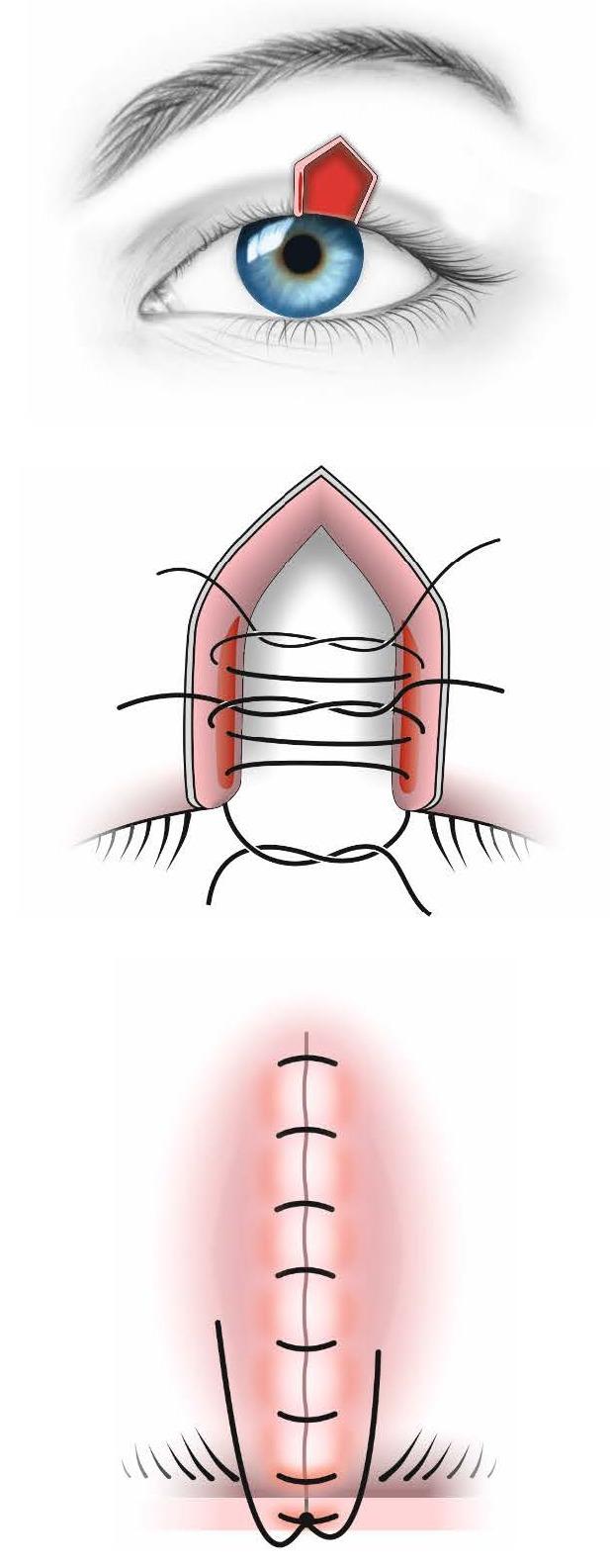 https://cdn.ncbi.nlm.nih.gov/pmc/blobs/7070/6117527/6303d82d6305/RomJOphthalmol-62-96-g005.jpg