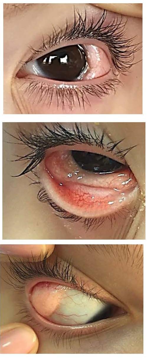 https://cdn.ncbi.nlm.nih.gov/pmc/blobs/7070/6117527/e79ad17fca14/RomJOphthalmol-62-96-g0013.jpg