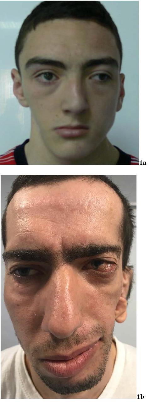 https://cdn.ncbi.nlm.nih.gov/pmc/blobs/7070/6117527/f32b2abd88da/RomJOphthalmol-62-96-g001.jpg