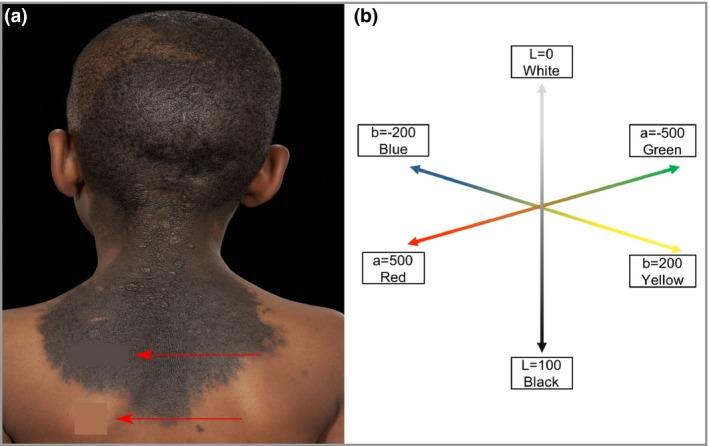 https://cdn.ncbi.nlm.nih.gov/pmc/blobs/70cb/7187277/8379a1098022/BJD-182-721-g001.jpg
