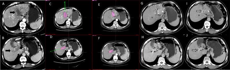 https://cdn.ncbi.nlm.nih.gov/pmc/blobs/70cc/8733476/dde111d4cf71/fonc-11-806907-g003.jpg