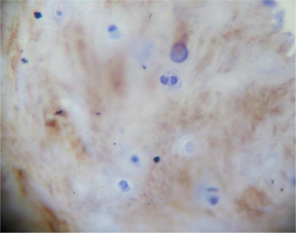 https://cdn.ncbi.nlm.nih.gov/pmc/blobs/70e1/4797241/362c6b5b4e9e/10.1177_1947603515621998-fig6.jpg