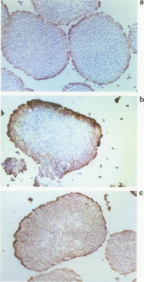https://cdn.ncbi.nlm.nih.gov/pmc/blobs/70ef/1968697/4d455e97a4b5/brjcancer00192-0049-a.jpg