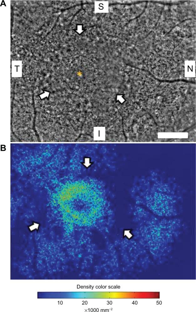 https://cdn.ncbi.nlm.nih.gov/pmc/blobs/7116/3558310/e0d8457fe906/opth-7-203Fig2.jpg