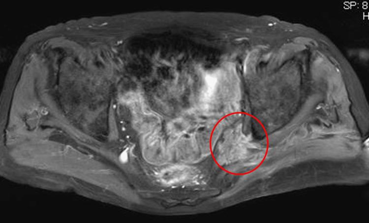https://cdn.ncbi.nlm.nih.gov/pmc/blobs/712c/10208137/59148bcdc456/cureus-0015-00000038057-i03.jpg
