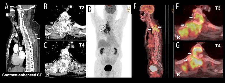 https://cdn.ncbi.nlm.nih.gov/pmc/blobs/7137/10009649/d0cf4f6b4695/amjcaserep-24-e939368-g003.jpg