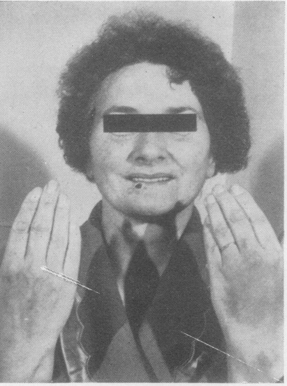 https://cdn.ncbi.nlm.nih.gov/pmc/blobs/713b/472717/f5e847557beb/thorax00111-0078-a.jpg