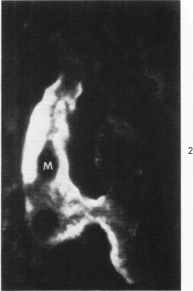 https://cdn.ncbi.nlm.nih.gov/pmc/blobs/715a/2013357/0d4bbcc0628c/amjpathol00428-0074-b.jpg