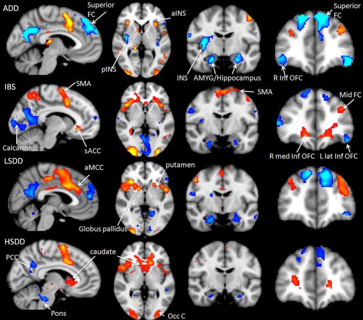 https://cdn.ncbi.nlm.nih.gov/pmc/blobs/7176/4879512/aa3aaced5b19/NMO-28-900-g003.jpg