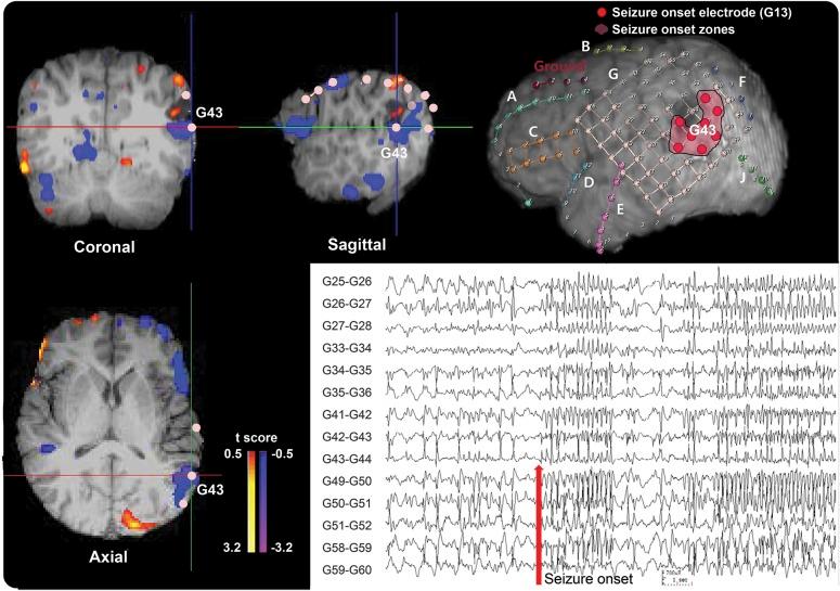 https://cdn.ncbi.nlm.nih.gov/pmc/blobs/7196/4277677/1fbc3dbb54dd/NEUROLOGY2013529446FF2.jpg