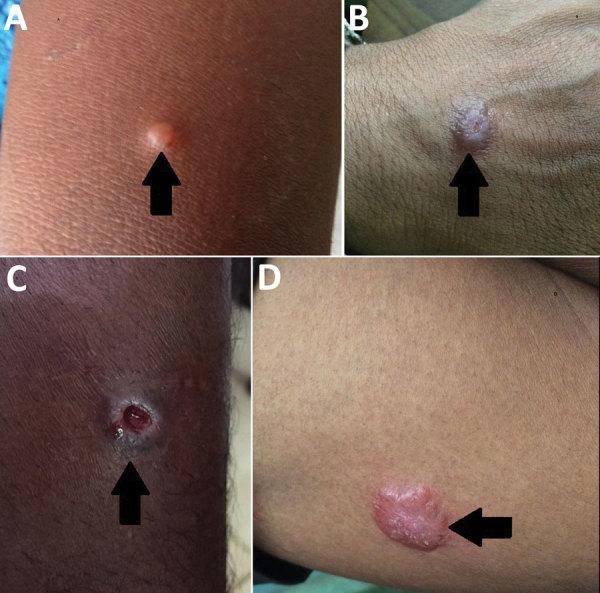 https://cdn.ncbi.nlm.nih.gov/pmc/blobs/71ae/6924882/ed37cef061e1/19-0971-F1.jpg