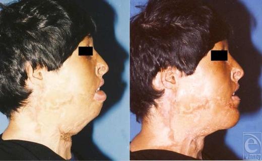 https://cdn.ncbi.nlm.nih.gov/pmc/blobs/71b0/2791702/33c590b11815/eplasty09e57_fig9.jpg