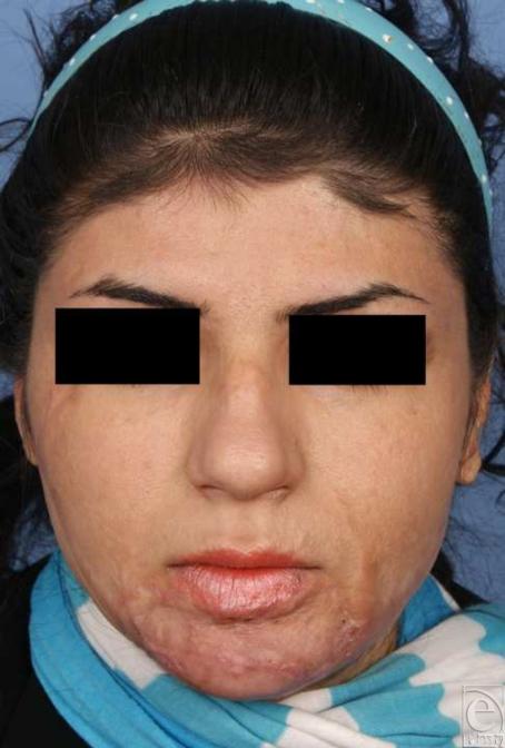 https://cdn.ncbi.nlm.nih.gov/pmc/blobs/71b0/2791702/5442067a1147/eplasty09e57_fig6.jpg