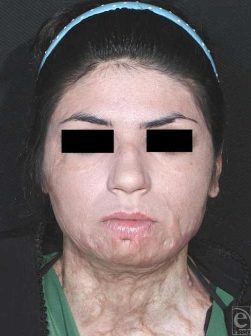 https://cdn.ncbi.nlm.nih.gov/pmc/blobs/71b0/2791702/6604ddb6db9c/eplasty09e57_fig4.jpg