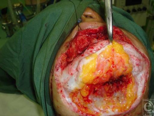 https://cdn.ncbi.nlm.nih.gov/pmc/blobs/71b0/2791702/a24131fe007a/eplasty09e57_fig1.jpg