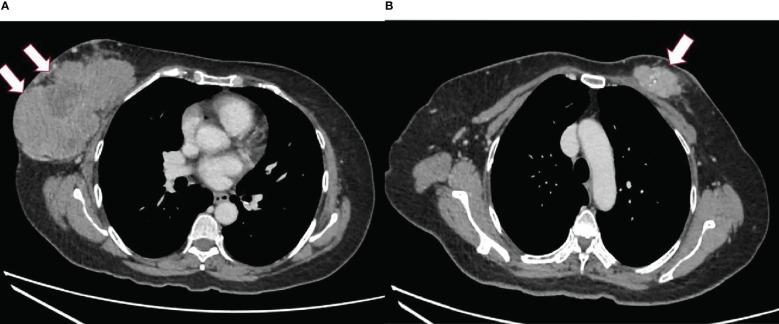 https://cdn.ncbi.nlm.nih.gov/pmc/blobs/71b6/10080590/d017e7da256b/fonc-13-1034556-g001.jpg