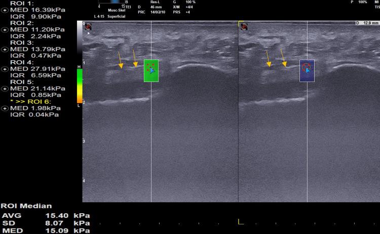 https://cdn.ncbi.nlm.nih.gov/pmc/blobs/71c3/11168960/f050620a5ac9/cureus-0016-00000060231-i04.jpg