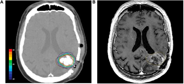 https://cdn.ncbi.nlm.nih.gov/pmc/blobs/71c6/11331313/63907244f2e5/fbioe-12-1432189-g012.jpg