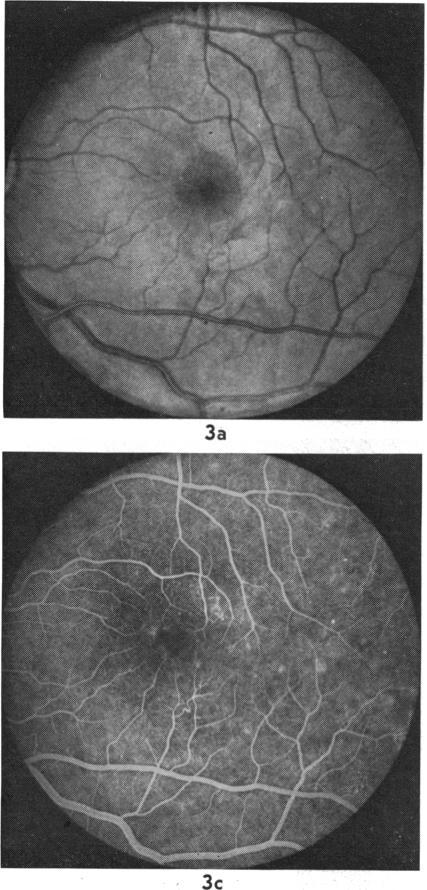 https://cdn.ncbi.nlm.nih.gov/pmc/blobs/7202/1039509/52d0e3f6abb0/brjopthal00185-0014-a.jpg