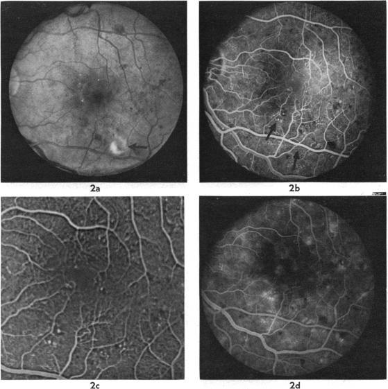 https://cdn.ncbi.nlm.nih.gov/pmc/blobs/7202/1039509/700d69e8a583/brjopthal00185-0013-a.jpg