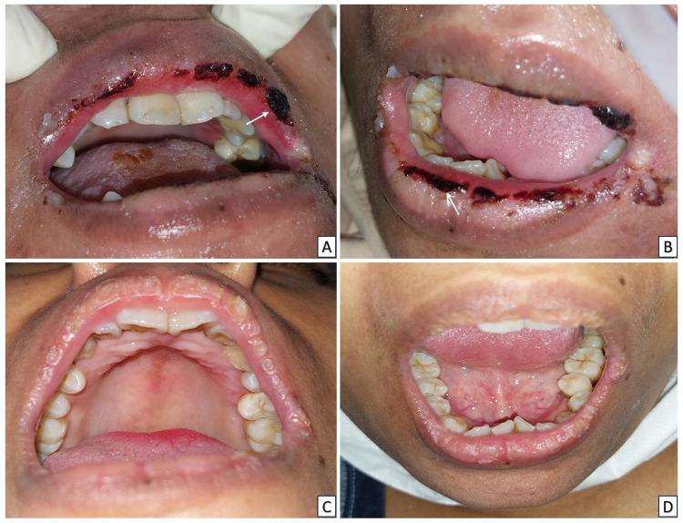https://cdn.ncbi.nlm.nih.gov/pmc/blobs/7205/11288364/fae07e3c9d69/HIV-16-289-g0005.jpg
