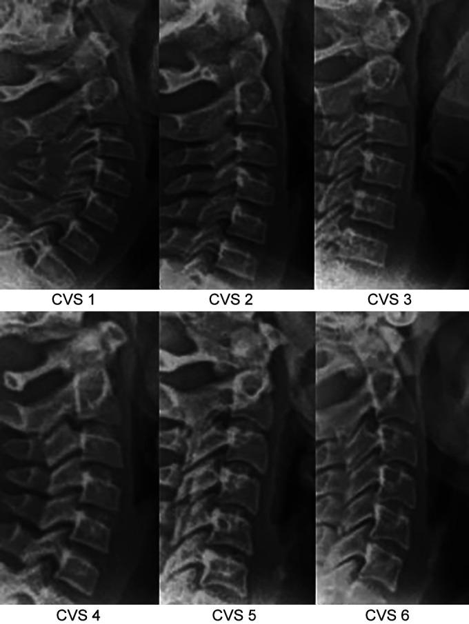 https://cdn.ncbi.nlm.nih.gov/pmc/blobs/723b/9973104/bb60020badf7/ijcpd-15-569-g002.jpg