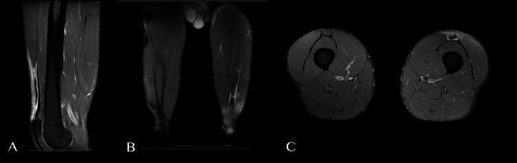 https://cdn.ncbi.nlm.nih.gov/pmc/blobs/728f/10584386/7d20a0fb0fd5/cureus-0015-00000045494-i01.jpg