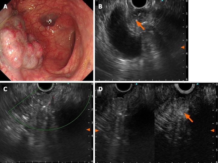 https://cdn.ncbi.nlm.nih.gov/pmc/blobs/729a/10989353/64e78d3aa06e/WJGS-16-966-g003.jpg