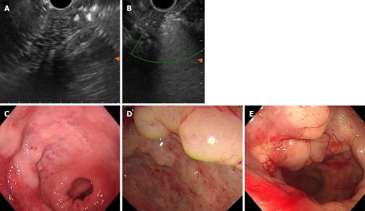 https://cdn.ncbi.nlm.nih.gov/pmc/blobs/729a/10989353/cb36e14e4f89/WJGS-16-966-g004.jpg