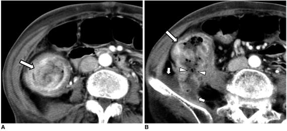 https://cdn.ncbi.nlm.nih.gov/pmc/blobs/729e/2827785/7371b9728a32/kjr-11-211-g006.jpg