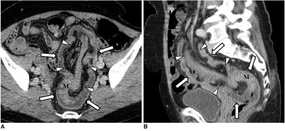 https://cdn.ncbi.nlm.nih.gov/pmc/blobs/729e/2827785/86b9e9b6d1db/kjr-11-211-g014.jpg