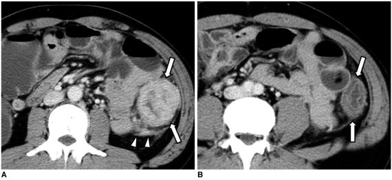 https://cdn.ncbi.nlm.nih.gov/pmc/blobs/729e/2827785/8ad25098f0e7/kjr-11-211-g012.jpg