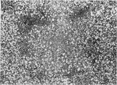 https://cdn.ncbi.nlm.nih.gov/pmc/blobs/72c7/2012485/46975a0a9d87/archdisch01612-0065-c.jpg