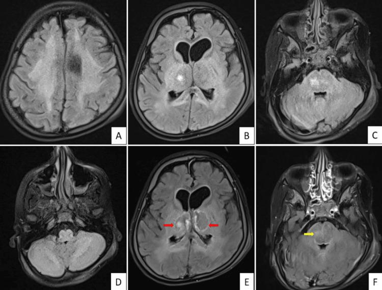 https://cdn.ncbi.nlm.nih.gov/pmc/blobs/72c8/10999109/4a4198ee06bc/cureus-0016-00000055780-i01.jpg