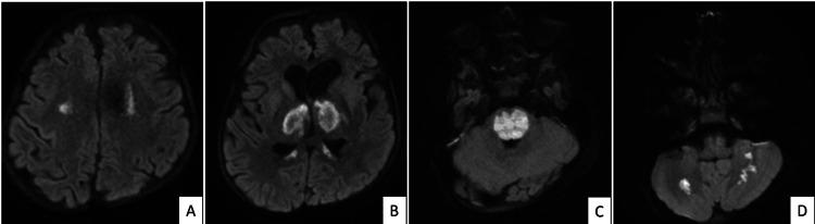 https://cdn.ncbi.nlm.nih.gov/pmc/blobs/72c8/10999109/595422649d71/cureus-0016-00000055780-i02.jpg