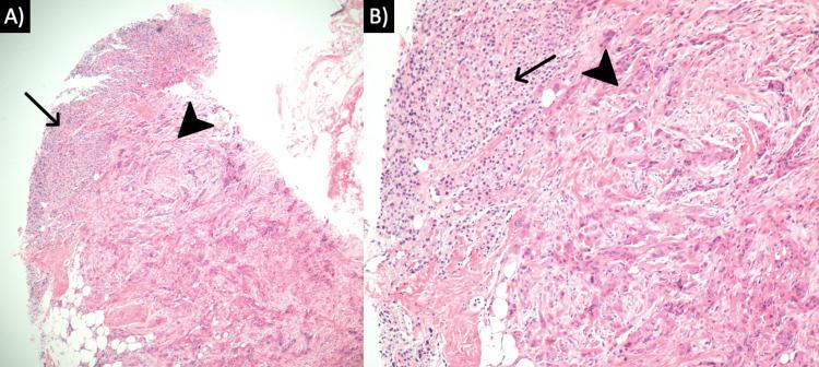 https://cdn.ncbi.nlm.nih.gov/pmc/blobs/72dd/9045959/0026be00613e/cureus-0014-00000023588-i01.jpg