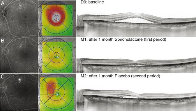 https://cdn.ncbi.nlm.nih.gov/pmc/blobs/72e2/4697359/7b4ed90ebe6d/retina-35-2505-g008.jpg