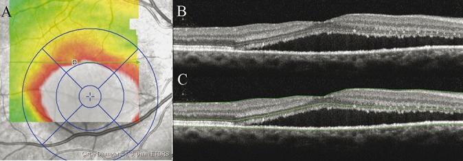 https://cdn.ncbi.nlm.nih.gov/pmc/blobs/72e2/4697359/8885e7325db5/retina-35-2505-g001.jpg