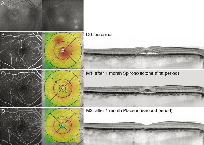 https://cdn.ncbi.nlm.nih.gov/pmc/blobs/72e2/4697359/c8bd64c68196/retina-35-2505-g009.jpg