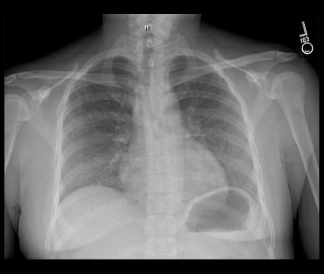 https://cdn.ncbi.nlm.nih.gov/pmc/blobs/734b/7733149/212f04a3d400/amjcaserep-21-e925200-g001.jpg