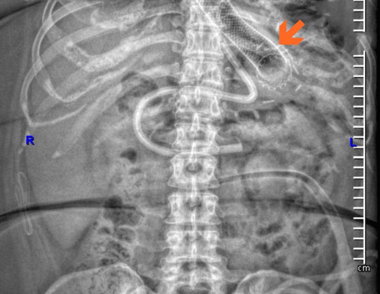https://cdn.ncbi.nlm.nih.gov/pmc/blobs/73e1/12394788/025b2e0e1d18/cureus-0017-00000088944-i03.jpg