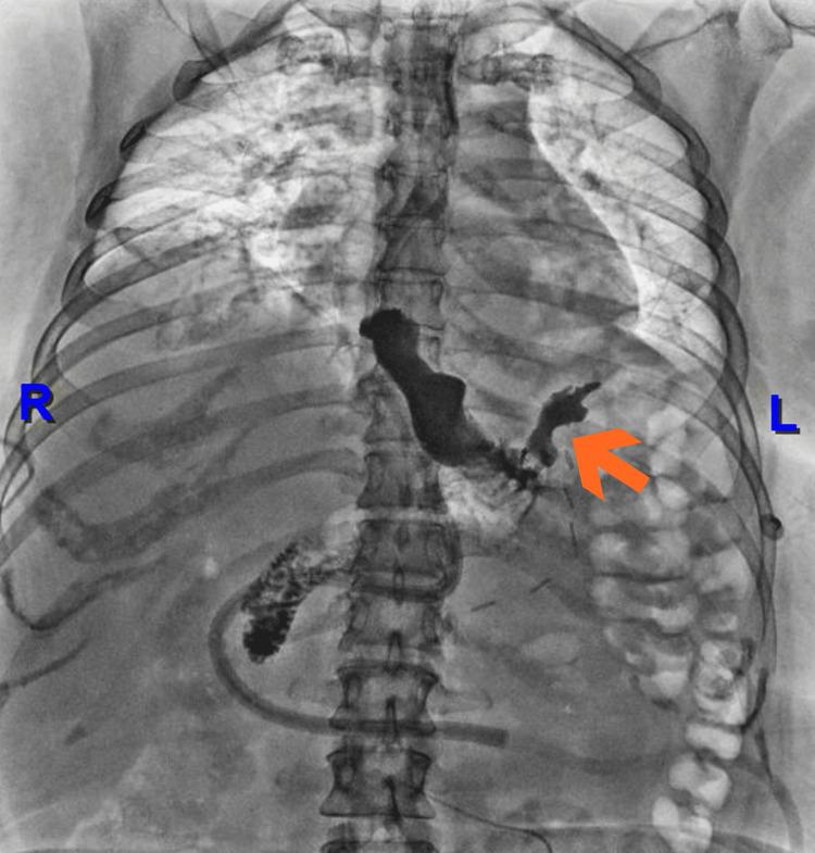 https://cdn.ncbi.nlm.nih.gov/pmc/blobs/73e1/12394788/32f5df3c52c4/cureus-0017-00000088944-i04.jpg
