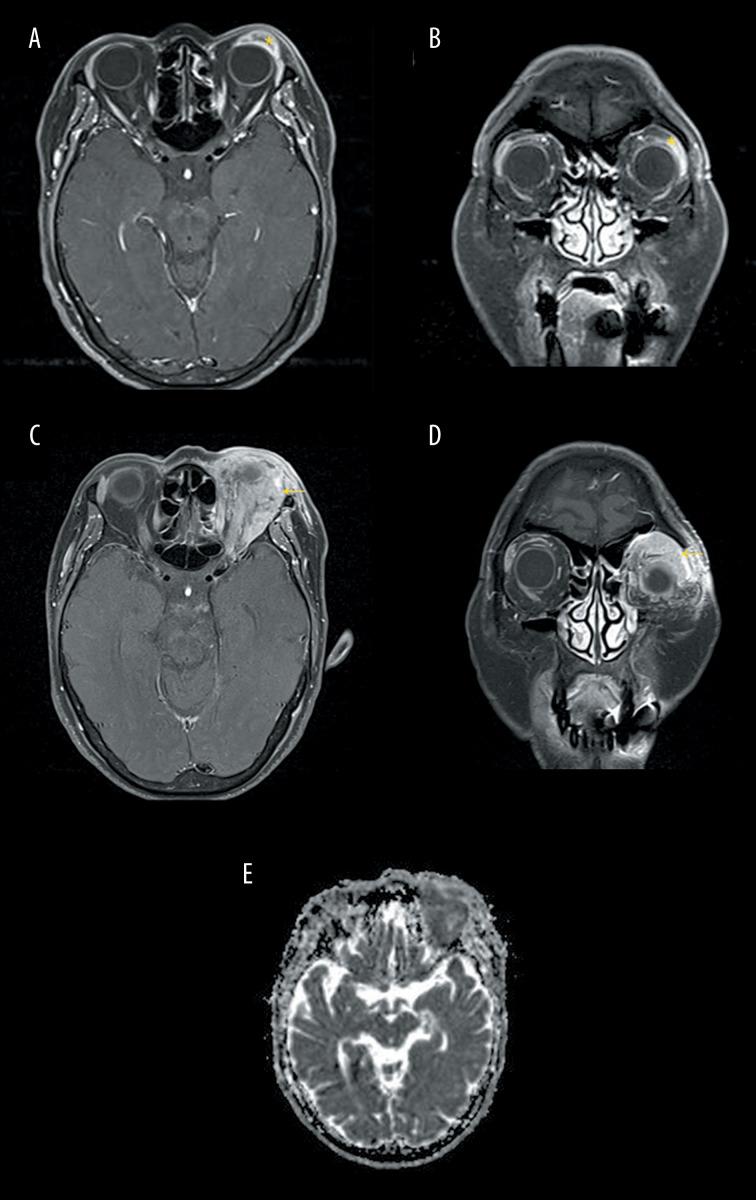 https://cdn.ncbi.nlm.nih.gov/pmc/blobs/746a/10838562/abf815ce24fc/amjcaserep-25-e942753-g002.jpg