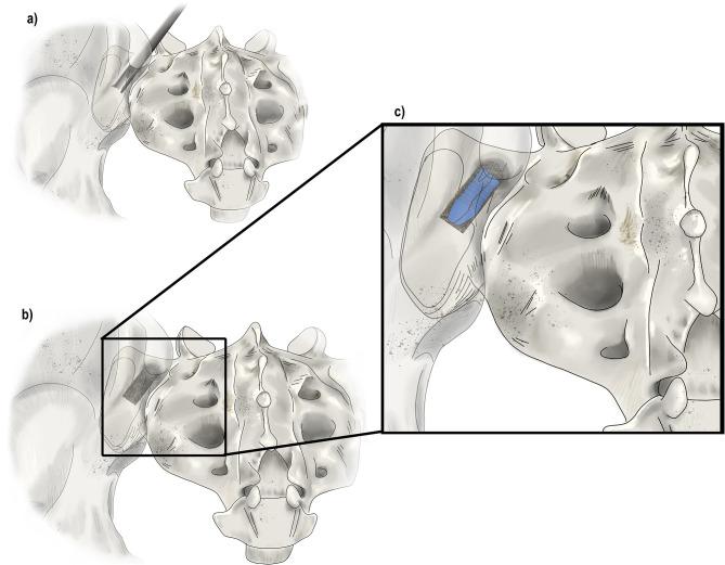 https://cdn.ncbi.nlm.nih.gov/pmc/blobs/7487/11075694/1b4ab897485c/JPR-17-1601-g0005.jpg