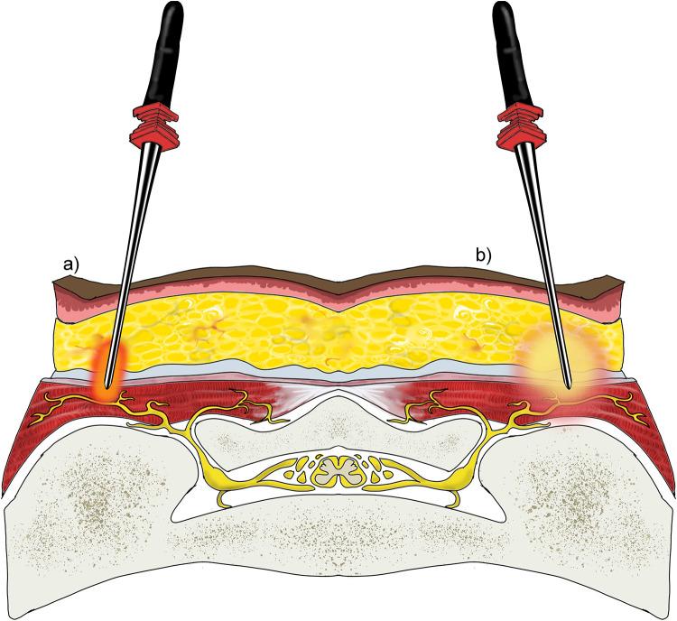 https://cdn.ncbi.nlm.nih.gov/pmc/blobs/7487/11075694/72dc6a067bf0/JPR-17-1601-g0003.jpg