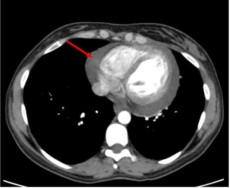 https://cdn.ncbi.nlm.nih.gov/pmc/blobs/749b/10911173/4c7cf1837504/cureus-0016-00000053501-i03.jpg