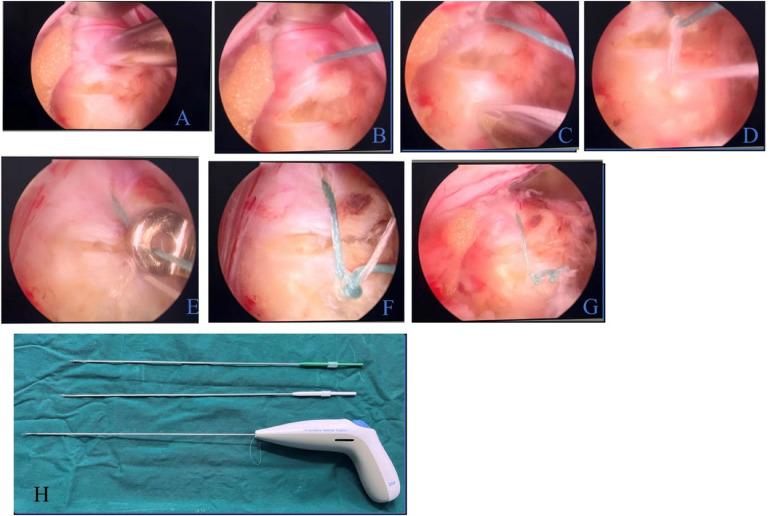 https://cdn.ncbi.nlm.nih.gov/pmc/blobs/74cf/12069353/56ae1574d183/fsurg-12-1521892-g003.jpg